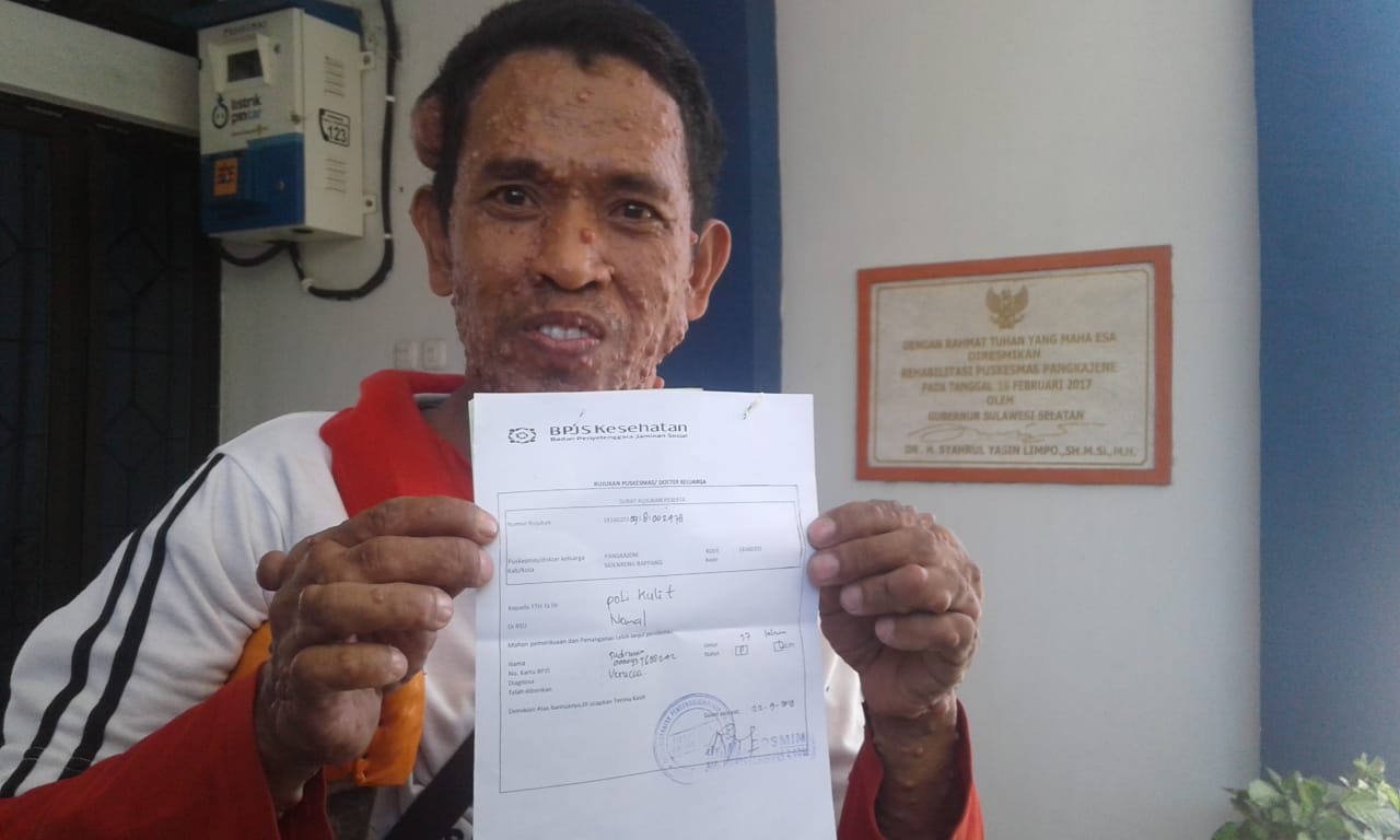 Mengidap Penyakit Misterius, Warga Sidrap Ini Dijuluki “Manusia Akar”