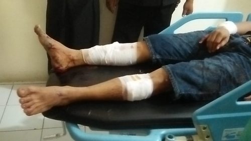 Kaki dan tangan korban penyerangan OTK diperban usai mendapat perawatan di rumah sakit.